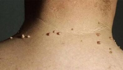 The reasons for the appearance of papillomas on the human body