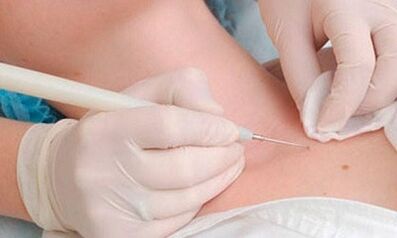Papillomas removal methods on the neck