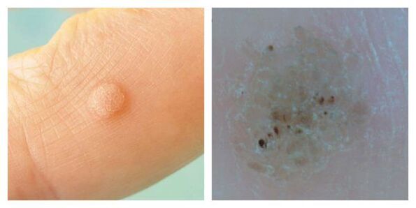 Ordinary wart during examination and dermatoscopy