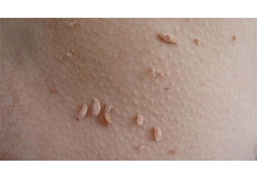 A sign of HPV infection is the appearance of papillomas on the body