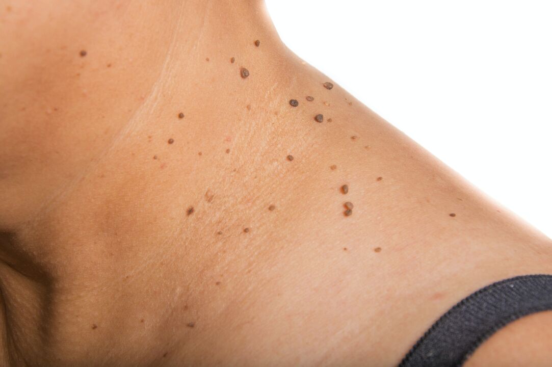 a scattering of papillomas on the neck
