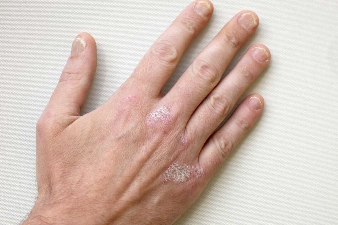 psoriasis on the hands of a man treatment with Keramin cream